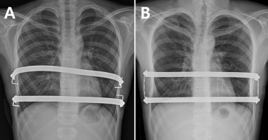 분리고정(A)과 사각고정(B)을 실시한 오목가슴 환자의 흉부 엑스레이 사진