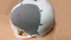 환자용 두개골에 맞춘 의료용 3D 프린팅 모델