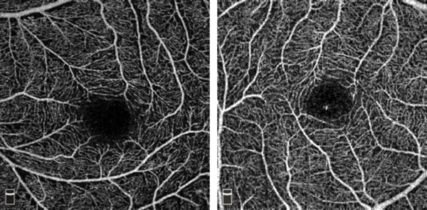 빛간섭단층촬영 혈관조영술(OCTA)을 이용한 근시안(좌)과 정상안(우) 황반부 망막혈관 비교 사진