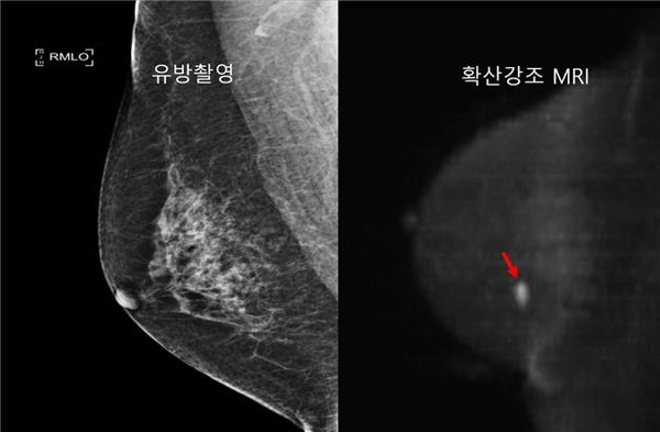 유방촬영에서 보이지 않는 유방암이 확산강조 MRI에서 고신호(화살표)로 보임