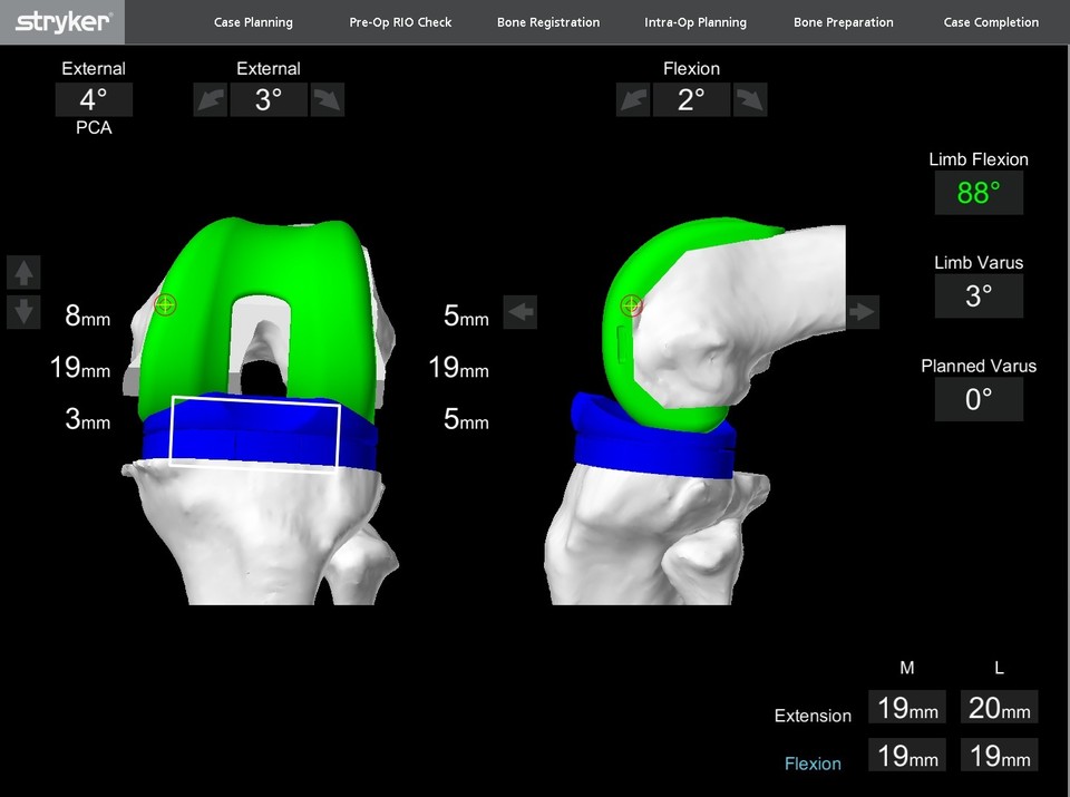 다리 축과 인대 균형을 맞추는 3D 시뮬레이션 장면