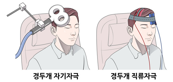 경두개 자기자극 치료(좌), 경두개 직류자극 치료(우). 경두개 자기자극은 머리 표면의 전자기 코일에서 발생한 자기장을 통해 신경 세포를 자극한다. 경두개 직류자극은 두피 위에 설치한 전극에서 뇌 표면으로 약한 직류자극을 보내 신경 세포를 활성시킨다.