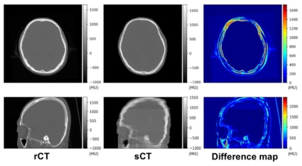 왼쪽 첫 번째(rCT)는 일반 CT 사진, 가운데(sCT)는 MRI에서 CT 정보를 유추한 사진이다. 맨 오른쪽 사진(Difference map)에서 rCT와 sCT의 차이를 의미하는 붉은 색이 거의 없는 것을 확인할 수 있다.