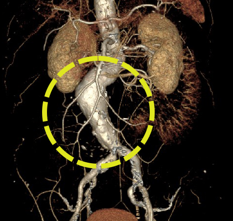 복부대동맥류 환자의 3D CT 사진