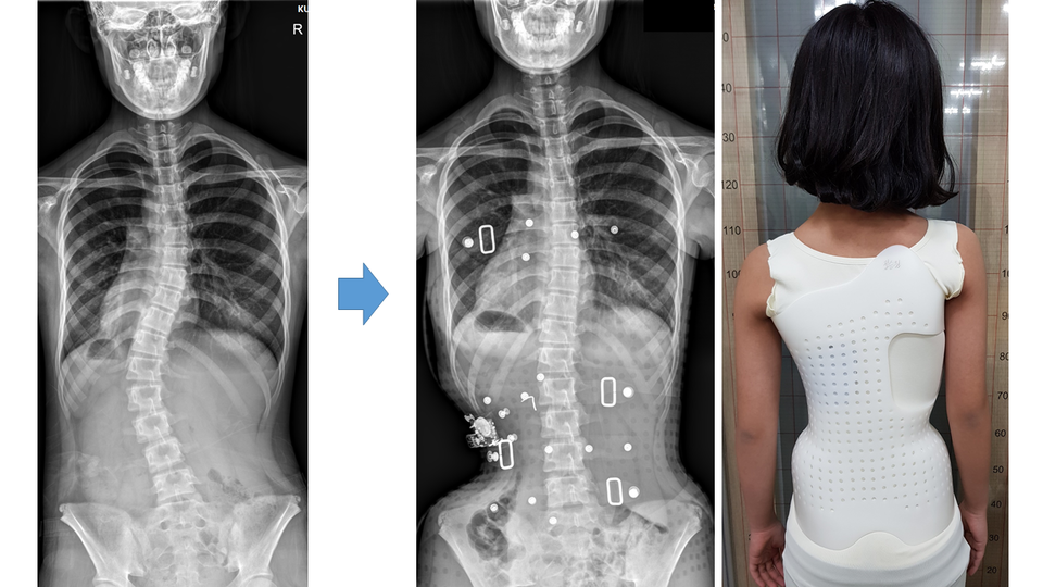 특발척추측만증 환자의 보조기 치료