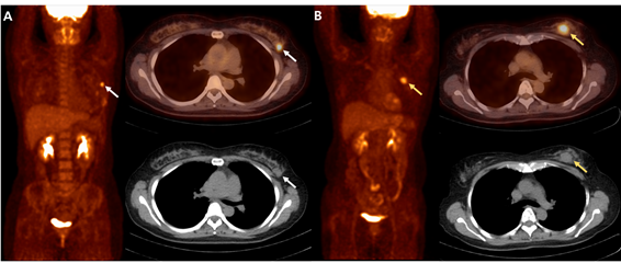 병기가 같은 조기 유방암 환자 두 명의 FDG PET/CT 영상. A 환자(50세, 왼쪽, 암 크기 2.8 cm, MTV 1.6 mL, 수술 후 7년 11개월까지 아직 재발하지 않음). B 환자(59세, 오른쪽, 암 크기 2.5 cm, MTV 4.4 mL, 수술 후 3년 2개월 뒤 재발함). B 환자가 A 환자보다 MTV가 높아 FDG PET/CT 영상에서 유방암이 더 크게 빛나고 있다.