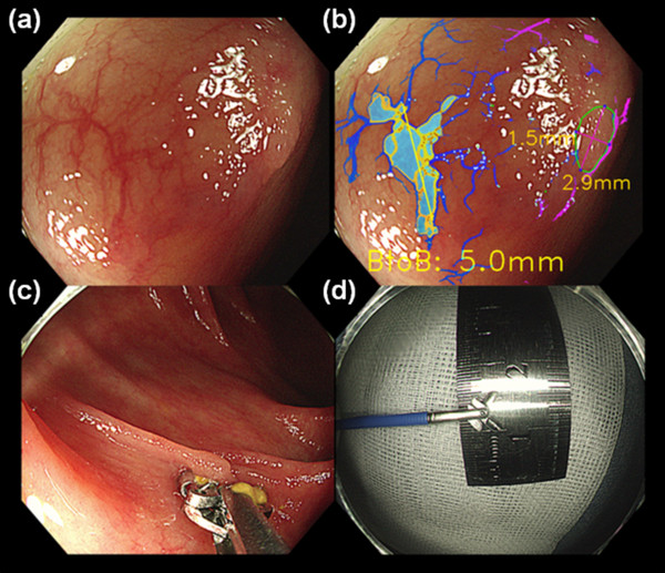대장내시경 사진(a)에서 AI가 주변 혈관을 분석해 용종 크기를 측정한 모습(b). 개방형 생검 겸자를 통해 측정한 방법(c), (d)와도 일치하는 결과를 보여준다. (사진(d)의 길이 6mm는 직경이므로, 1/2이 용종 크기이다)