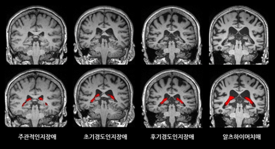 뇌 영상에서 맥락얼기의 부피(빨간색)가 치매가 진행함에 따라 더 증가한 것을 확인할 수 있다.