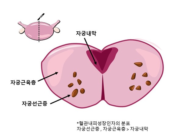 자궁선근증이 있는 환자에게서 채취한 자궁내막, 자궁근층, 자궁선근증 60개의 조직을 통해 혈관내피성장인자의 분포를 살핀 결과