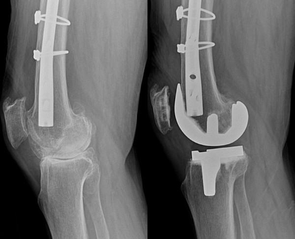 대퇴골수안에 철심이 삽입(사진 왼쪽)되어 있지만, 수술 전 시뮬레이션에서 CT촬영으로 정보 분석 후 철심 제거없이 인공관절 수술을 성공(사진 오른쪽)시킨 모습.