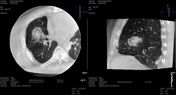 대장암 폐 전이 고주파 열치료 시술 직후 Cone Beam CT 소견