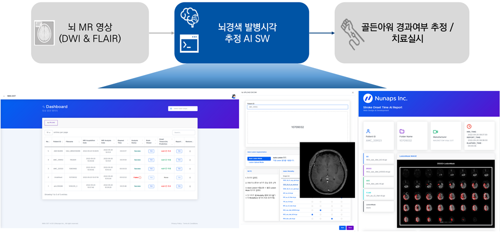 뇌경색 발병시간 추정 의료 AI 소프트웨어