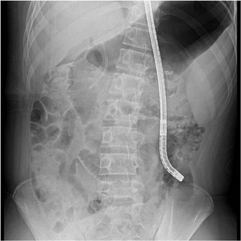 내시경적 괴사제거술 X-ray 사진.