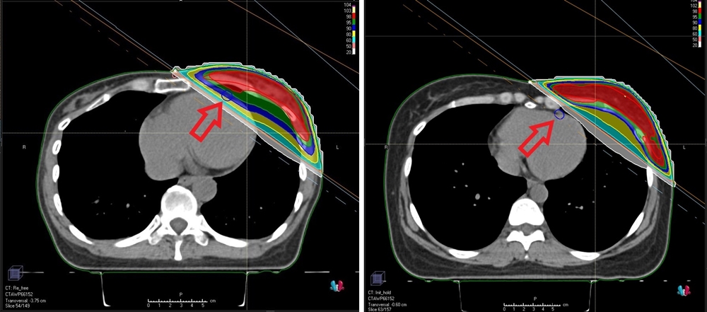 (왼쪽)일반적인 유방암 방사선치료 시 설계화면. 화살표가 가리키는 파란색 동그라미가 심장의 관상동맥으로, 방사선 치료범위에 관상동맥이 위치해 있다. (오른쪽)브레스홀딩 방사선치료 시 설계화면. 관상동맥(파란색 동그라미)이 방사선 치료범위에서 벗어나 안전한 치료가 가능하다.