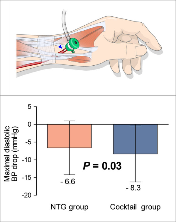 (위) 손등 부위 동맥을 통한 스너프박스 접근법(최소절개 접근법)의 모식도. (아래) 니트로글리세린 단독 용액 주입 그룹(NTG group)과 비교해 니트로글리세린-베라파일 혼합 용액 주입 그룹(Cocktail group)에서 최대 이완기 혈압이 평균적으로 더 낮아지는 것으로 나타났다.