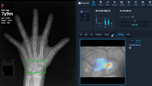 안국약품과 공동판매 계약을 체결한 크레스콤의 골연령측정 AI ‘MediAI-BA’