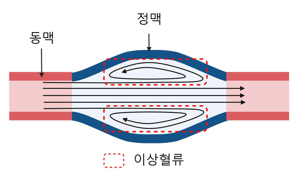 투석혈관에서 발생하는 이상혈류