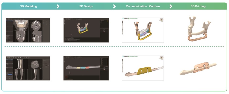 3D 프린팅 기술을 이용해 가이던스를 제작하는 과정