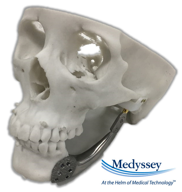 3D프린팅으로 제조된 환자맞춤형 인공 하악골 사진