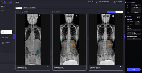 SMedi-AI를 이용한 척추측만증 진단 결과 화면
