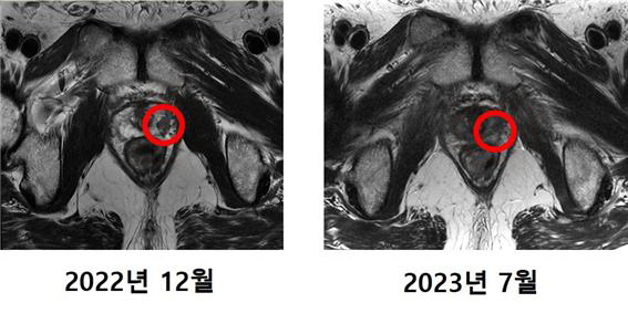 최 씨의 MRI 촬영 사진. 기존에 발견됐던 암 조직(왼쪽 사진 표시)이 치료 후에는 발견되지 않았다.