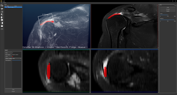 Multiplanar reformation view. 빨간색 영역은 자동으로 분할된 RCT 병변을 나타낸다. 분할된 영역은 다중면(coronal, axial, sagittal) 방향으로 자유롭게 제어해 볼 수 있다.