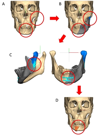 환자 맞춤형 안골절수술 모식도. (A)환자의 CT를 3차원적으로 재구성 (B)가상 수술로 골절편을 재위치로 정복한 모습 (C)환자 맞춤형 금속판 디자인 (D)환자 맞춤형 수술 가이드 디자인.