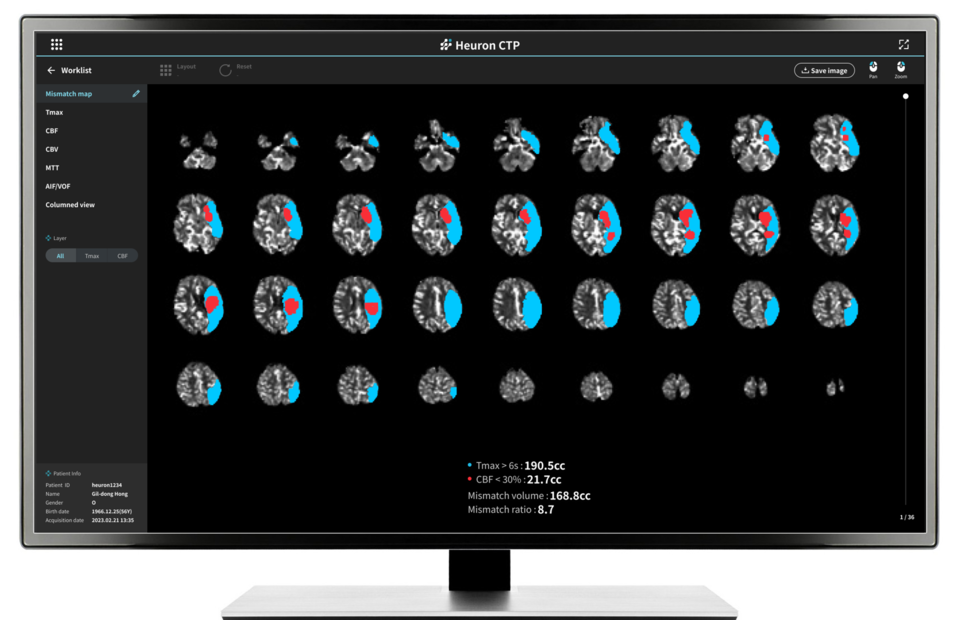 Heuron CTP (뇌 CT 관류 영상 분석 인공지능 솔루션)