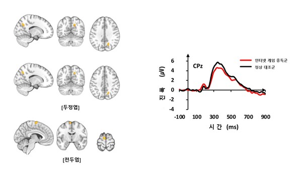 기능적 MRI 검사 결과 인터넷 게임 중독군은 정상대조군들보다 두정엽과 전두엽 부위에서 뇌 활성이 증가했다(좌측 사진). 청각 자극에 대한 뇌파 신호의 진폭은 인터넷 게임 중독군이 정상대조군보다 감소했다(우측 그래프).