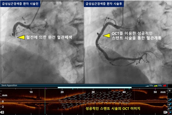 급성심근경색증 환자의 심장혈관 영상검사 이미지. 스텐트 시술 전 혈전에 의해 혈관이 막힌 모습(왼쪽 상단)과 시술 후 막힌 혈관이 뚫린 모습(오른쪽 상단), 성공적인 스텐트 시술의 OCT 이미지(하단).