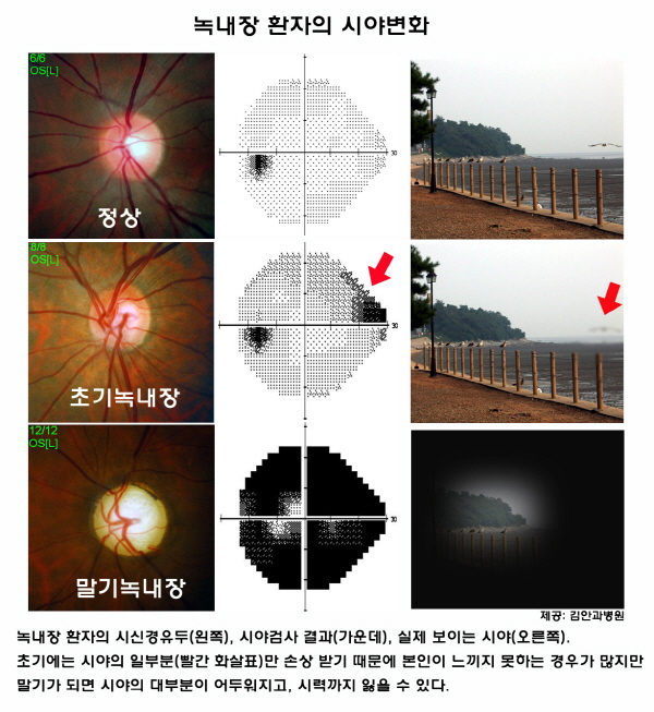 공주안과 녹내장에 대해 알고 싶다면?