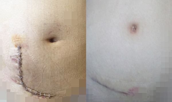 기존 복부절개 신장이식 수술법과 최소절개 수술법 비교 사진