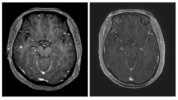 타그리소 복용 전(왼쪽)과 복용 3개월 후(오른쪽) CT 사진. 하얀색이던 암 조직이 확연히 줄어들었다.