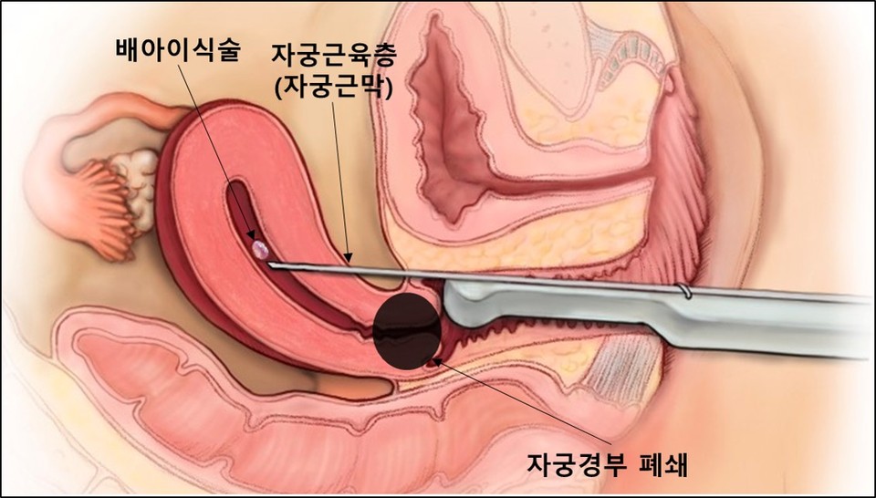 자궁경부가 폐쇄된 경우 시행할 수 있는 ‘자궁근막 통과 배아이식술’