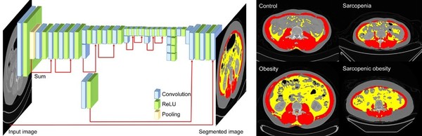(왼쪽)CT영상에서 인공지능을 이용해 몸의 체성분을 분류하는 과정. (오른쪽)체성분에 따라 정상, 비만, 근감소증, 근감소성 비만의 대표적인 CT영상을 근육과 내장지방으로 구분한 이미지(빨간부분 : 근육, 노란부분 : 내장지방)