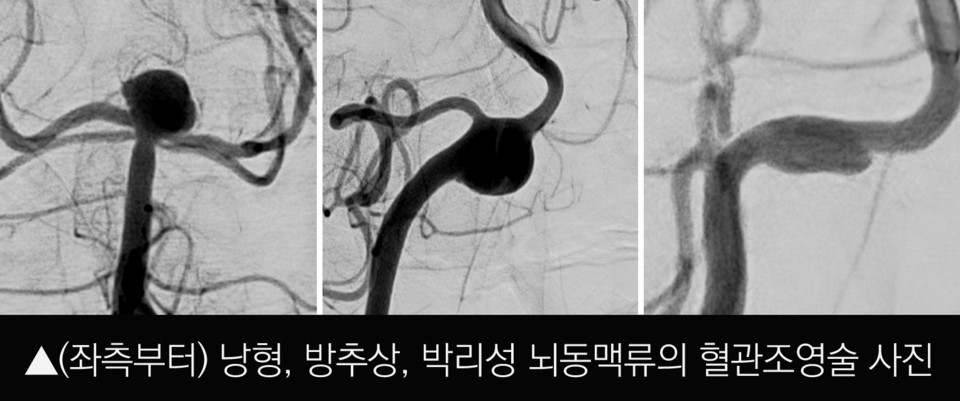 사진 좌측부터 낭형, 방추상, 박리성 뇌동맥류의 혈관조영술 사진