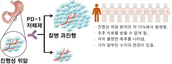 진행성 위암 환자에서 면역관문억제제(PD-1 저해제) 투여에 따른 결과.