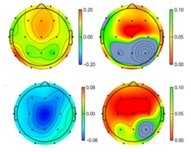 알코올 금단성 경련 환자(오른쪽)와 대조군(왼쪽)의 뇌파 파형 비교: 알코올 금단성 경련 환자의 뇌파에서 대조군에 비해 인지 및 기억 기능과 관련된 알파파형(녹색계열, 위쪽)과 베타파형(청색계열, 아래쪽)이 유의하게 감소했다.