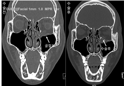 안와골절 수술 전후 CT사진